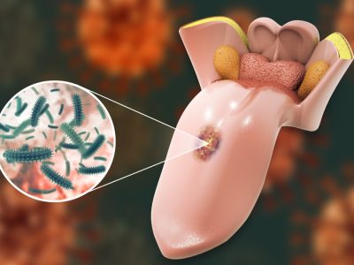 Tongue,Cancer,Medical,Concept,Or,Squamous,Cell,Carcinoma,As,Malignant